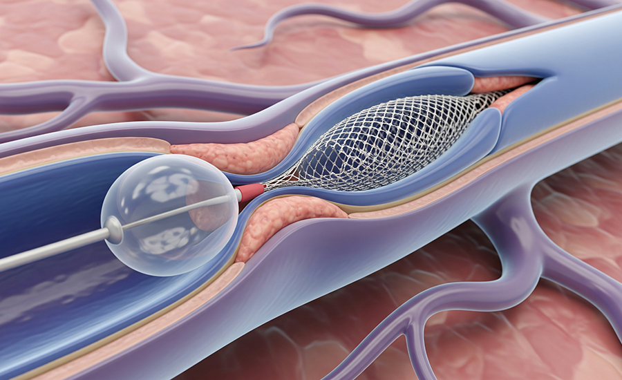 Interventional Catheters